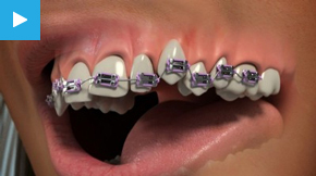 Orthodontics & Invisible Braces