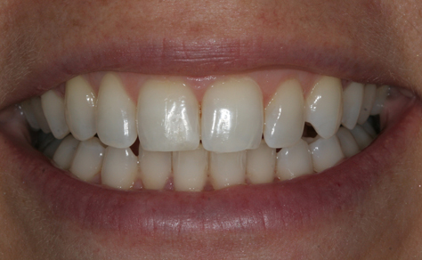 This shot was taken after Air n Go treatment and some home tooth whitening for 7 days.